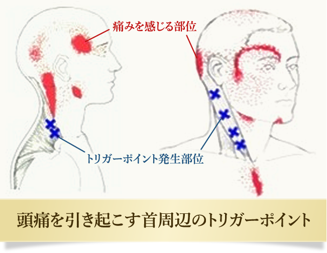 頭痛を引き起こす首周辺のトリガーポイント